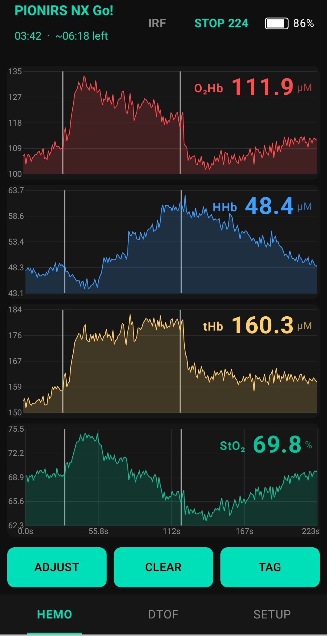Mobile app showing the same live hemodynamic traces